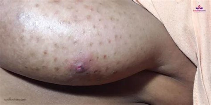 Is it normal to have pores on your breast?