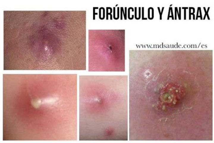 ¿Por qué salen los forunculos?