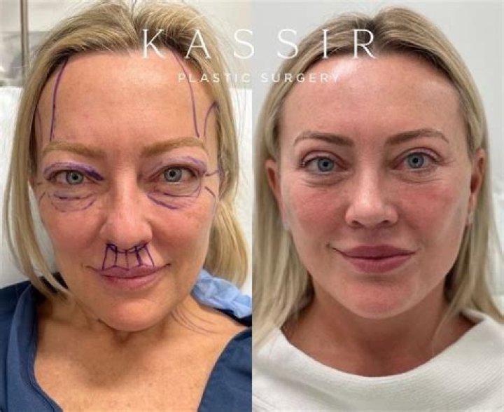 Sia loves her plastic surgery results: ‘I got an amazing face lift’