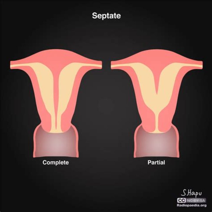 What is a telescoping uterus?